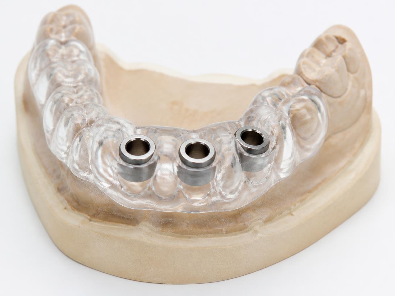 Clear implant surgical guide with guide sleeves