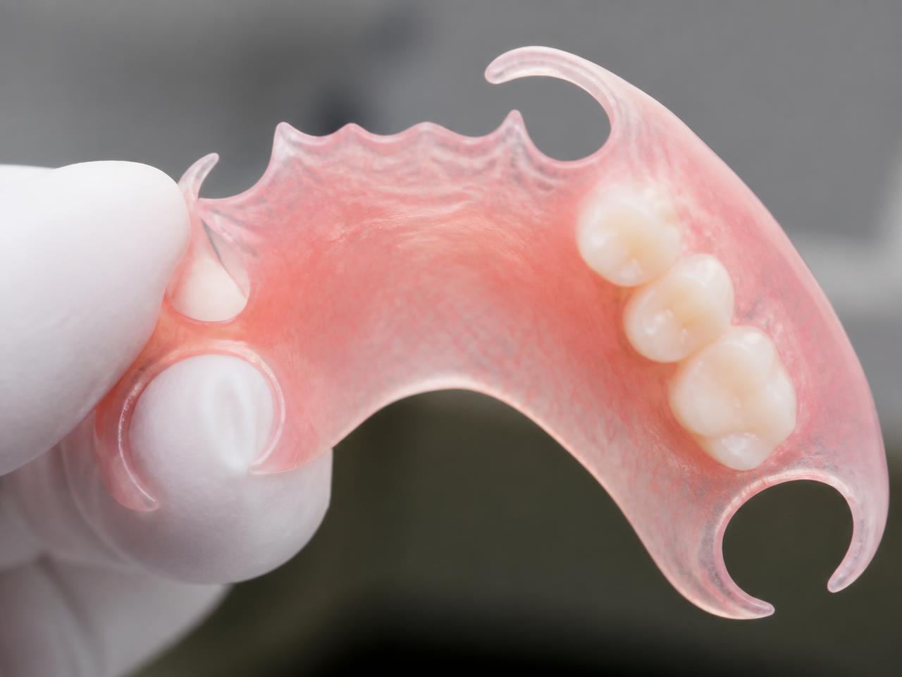 Flexible Valplast-style partial denture