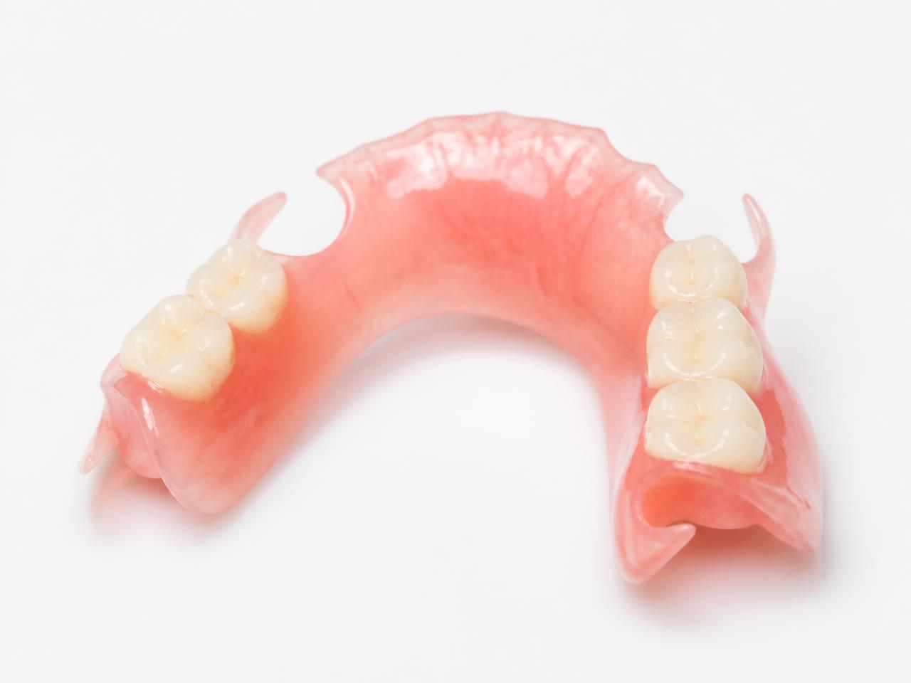Removable partial denture with acrylic base and natural-looking teeth